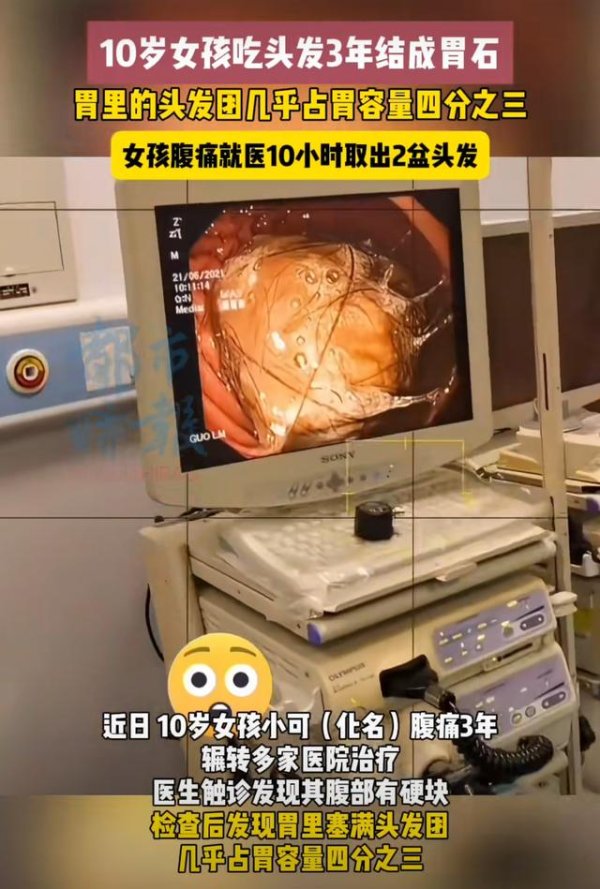嘉正网  10岁女孩吃头发3年，胃几乎被塞满，手术10小时取出2盆头发